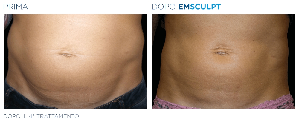 Emsculpt Addome Donna - Prima e Dopo il 4° Trattamento