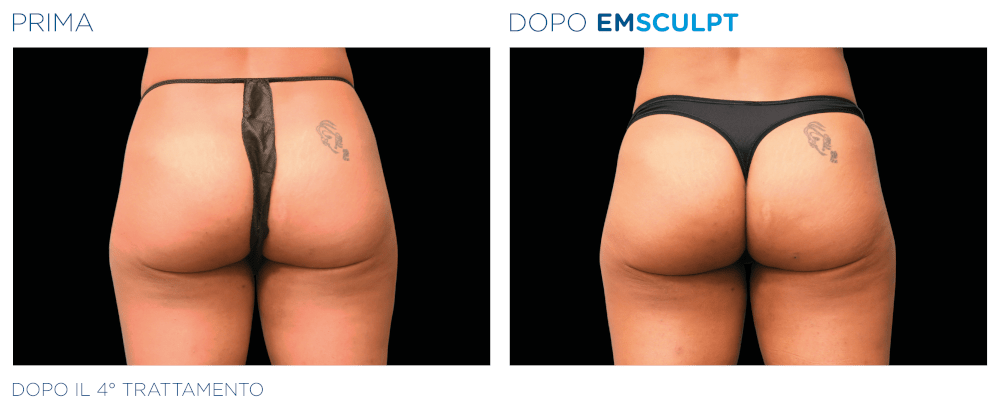 Emsculpt Glutei Donna - Prima e Dopo il 4° Trattamento