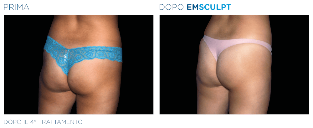 Emsculpt Glutei Donna - Prima e Dopo il 4° Trattamento