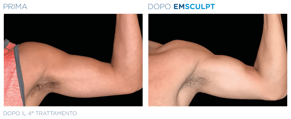 Emsculpt Braccia Uomo - Prima e Dopo il 4° Trattamento