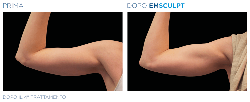 Emsculpt Braccia Donna - Prima e Dopo il 4° Trattamento